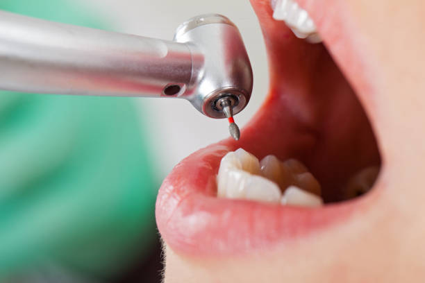 Best Broken or Chipped Tooth Repair in Buellton, CA